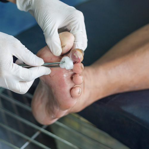 diabetic foot care